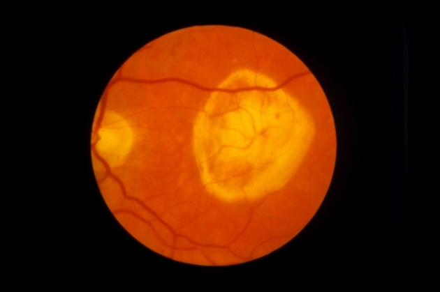 Retina