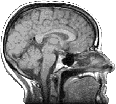 MRI brain