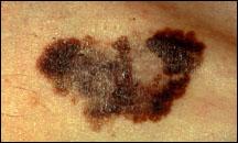 Picture of a melanoma.