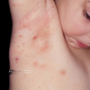 Molluscum bumps on a child.