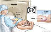 Biopsia de pulmón; el dibujo muestra a un paciente tendido sobre una camilla que se desliza a través de una máquina de tomografía computarizada (TC) y una imagen de una radiografía de un corte transversal del pulmón en un monitor encima del paciente. El dibujo también muestra a un médico usando la imagen radiográfica para ayudarlo a colocar la aguja de biopsia a través de la pared torácica, hasta el área del tejido anormal del pulmón. El dibujo del recuadro muestra una vista lateral de la cavidad torácica y los pulmones, con la aguja de biopsia insertada en el área de tejido anormal.