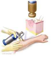 Cryosurgery; drawing shows an instrument with a nozzle held over an abnormal area on the lower arm of a patient. Inset shows a spray of liquid nitrogen or liquid carbon dioxide coming from the nozzle and covering the abnormal lesion. Freezing destroys the lesion.