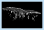 3D Reconstruction of Individual Senile Plaques Just Below the Surface of the Brain