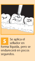 5. Se aplica el sellador en forma líquida, pero se endurecerá en pocos segundos.