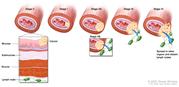 Esophageal  cancer staging; shows tumors growing through layers of the esophagus wall for Stage 0, Stage I, Stage II, Stage III, and Stage IV esophageal  cancer. Inset shows muscle, submucosa, and mucosa layers of the esophagus  wall, and lymph nodes.