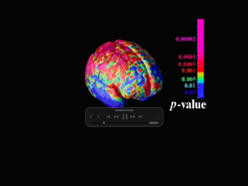 brain development in teens with childhood onset schizophrenia