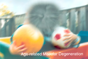 Age related macular degeneration