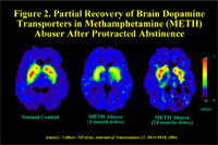 Figure 2. Partial Recovery of Brain Dopamine Transporters in Methamphetamine (METH) Abuser After Protracted Abstinence