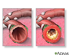 Illustration of normal bronchi and bronchi with bronchitis