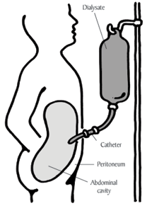 Peritoneal dialysis