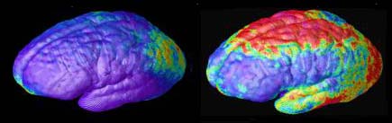 Rate of gray matter loss