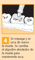 4. Se enjuaga y se seca de nuevo la muela. Se cambia el algodón alrededor de la muela para mantenerla seca.