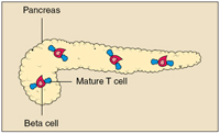 Pancreas with beta cell attacked by mature T cells.