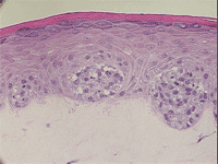 Ex vivo reconstructed skin model of melanoma. This skin sample contains melanoma cells without SOX9, which have formed invasive tumors. (Image courtesy of Drs. Thierry Passeron and Vincent Hearing.)