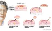 Mohs surgery; drawing shows a patient with skin cancer on the face. The pullout shows a block of skin with cancer in the epidermis (outer layer of the skin) and the dermis (inner layer of the skin). A visible lesion is shown on the skin’s surface. Four numbered blocks show the removal of thin layers of the skin one at a time until all the cancer is removed.