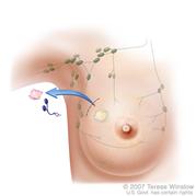 Biopsia de ganglio linfático centinela. La tercera de una ilustración de tres paneles, muestra la inyección de una substancia radiactiva o tinción azul cerca del tumor, a la substancia inyectada se le da seguimiento visual o mediante sonda y los primeros ganglios linfáticos en absorberla se extirpan y se analizan en busca de células cancerosas.