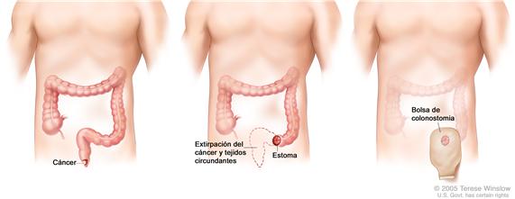 La ilustración a tres paneles muestra la cirugía de cáncer del ano con colostomía; primer panel muestra el área del ano con cáncer, el panel medio muestra la extirpación del cáncer y el tejido circundante y la creación de una estoma, el último panel muestra la colocación de la bolsa de colostomía junto a la estoma.