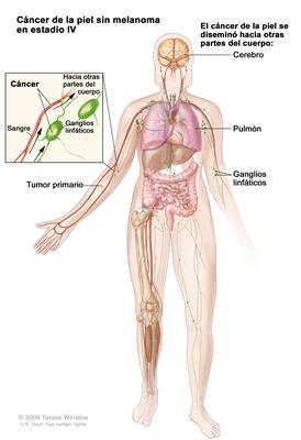 Cáncer de la piel en estadio IV sin melanoma; el dibujo muestra que el tumor primario se diseminó hacia otras partes del cuerpo, como el cerebro o el pulmón. La ampliación muestra el cáncer en los ganglios linfáticos, los vasos linfáticos y el vaso sanguíneo del brazo con el tumor primario.