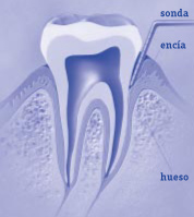 Midiendo la bolsa periodontal