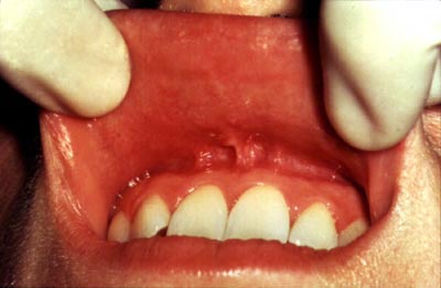 Photograph of examination of inside upper lip