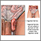 Hernia inguinal