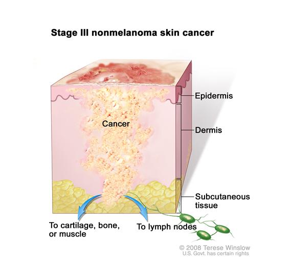 Stage III nonmelanoma skin cancer; drawing shows a tumor that has spread from the epidermis (outer layer of the skin) and dermis (inner layer of the skin) into the subcutaneous tissue and to cartilage, bone, or muscle below the skin and/or to nearby lymph nodes.