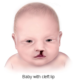 Baby with cleft lip