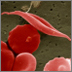 microscopic image of a sickle shaped red blood cell and a healthy red blood cell.