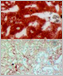 Two microscope images of liver, the top one heavily marbled with red.