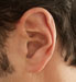 Severe Hearing Loss