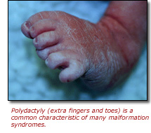 polydactyly