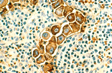 Microscopic image of a cluster of large cancer cells among smaller cells.