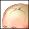 Illustration showing soft spots (fontanels) of a baby's skull 
