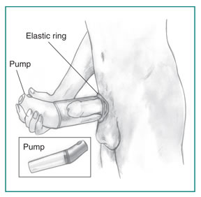 Drawing of a vacuum device placed around the penis to treat erectile dysfunction. Labels point to the pump, which draws air out of the cylinder, and an elastic ring, which, when fitted over the base of the penis, traps the blood and sustains the erection after the cylinder is removed. An inset shows the vacuum device when not in use.