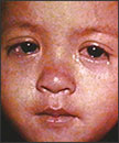 Ojos de un niño con sarampión.