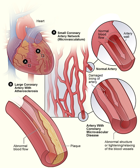 Figure A shows the small coronary artery network (microvasculature), containing a normal artery and an artery with coronary MVD. Figure B shows a large coronary artery with plaque buildup.