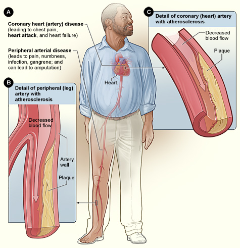 The image shows how smoking can affect arteries in the heart and legs. Figure A shows the location of coronary heart disease and peripheral arterial disease. Figure B shows a detailed view of a leg artery with atherosclerosis—plaque buildup that's partially blocking blood flow. Figure C shows a detailed view of a coronary (heart) artery with atherosclerosis.