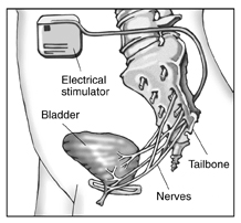 Diagram of electrical stimulation device implanted in a woman's abdomen. Labels point to the electrical stimulator, tailbone, bladder, and nerves.