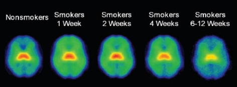 brain scans showing higher levels of beta-2 nicotinic acetylcholine receptors through 4 weeks of abstinence from smoking