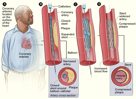 Figure A shows the location of the heart and coronary arteries. Figure B shows the deflated balloon catheter and closed stent inserted into the narrow coronary artery. The inset image shows a cross-section of the artery with the inserted balloon catheter and closed stent. In figure C, the balloon is inflated, expanding the stent and compressing the plaque against the artery wall. Figure D shows the stent-widened artery. The inset image shows a cross-section of the compressed plaque and stent-widened artery.