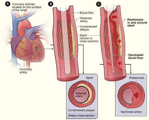 Figure A shows the coronary arteries located on the surface of the heart. Figure B shows a stent-widened artery with normal blood flow. The inset image shows a cross-section of the stent-widened artery. In figure C, tissue grows through and around the stent over time. This causes a partial blockage of the artery and abnormal blood flow. The inset image shows a cross-section of the tissue growth around the stent.