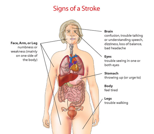 Signs of a stroke