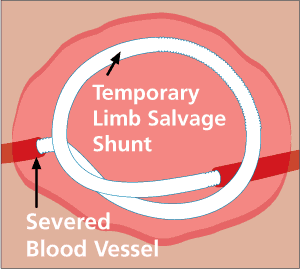 Illustration shows how the Temporary Limb Salvage Shunt  restores blood flow to an injured limb by connecting the severed ends of a blood vessel until a permanent repair can be made.