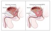 Two-panel drawing shows normal male reproductive and urinary anatomy and benign prostatic hyperplasia (BPH). Panel on the left shows the normal prostate and flow of urine from the bladder through the urethra. Panel on the right shows an enlarged prostate pressing on the bladder and urethra, blocking the flow of urine.