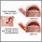 Gastroesophageal reflux disease