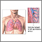 Pulmonary embolus