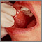 Lichen planus on the oral mucosa