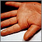 Kawasaki's disease - edema of the hand