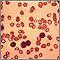 Chronic lymphocytic leukemia - microscopic view