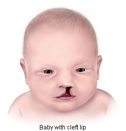 Baby with Cleft Lip